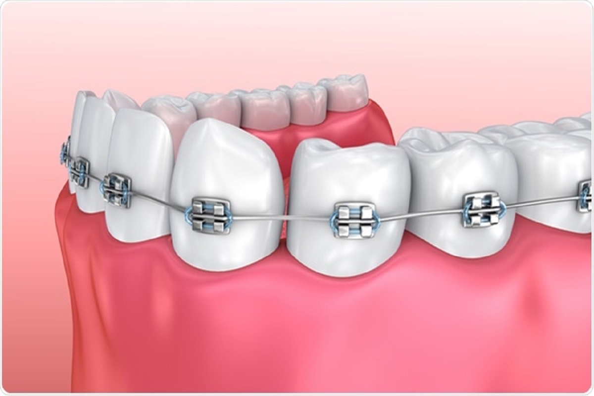 https://bramaleasmilesdentistry.ca/wp-content/uploads/2020/08/braces.jpg